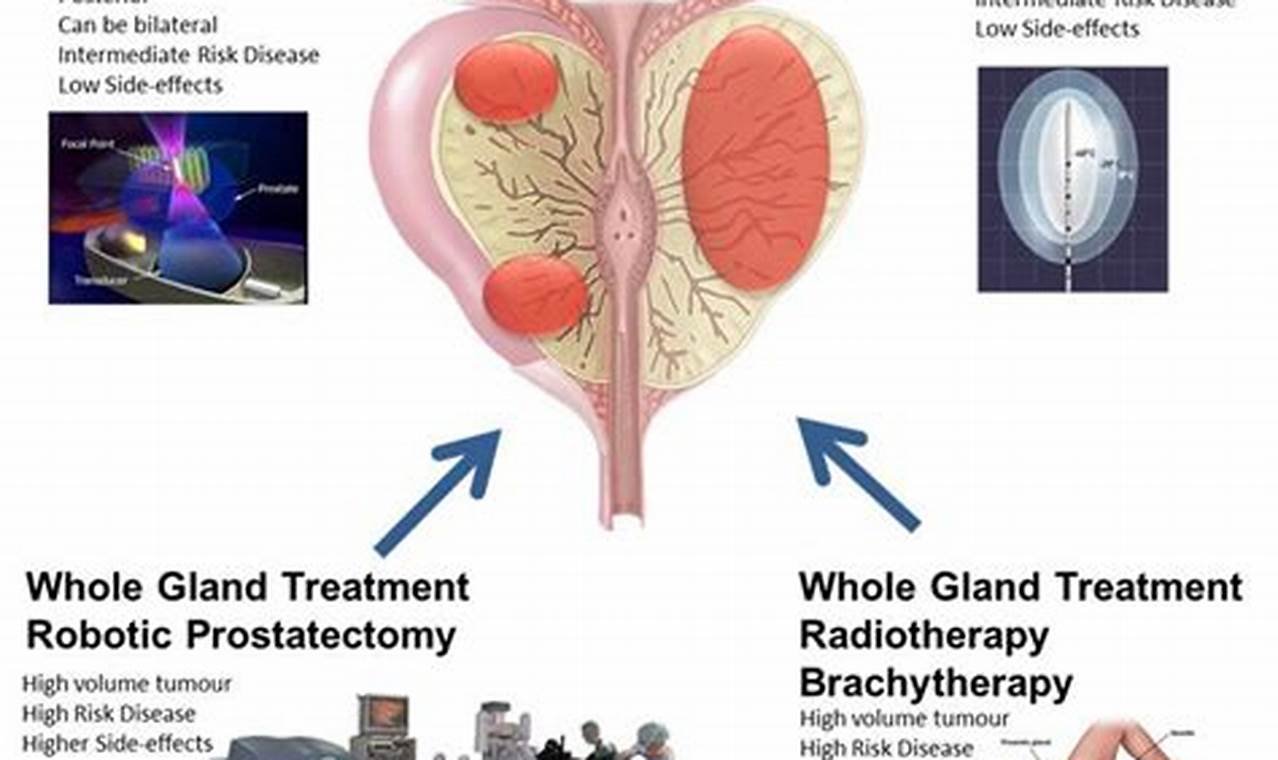 treatment options of prostate cancer